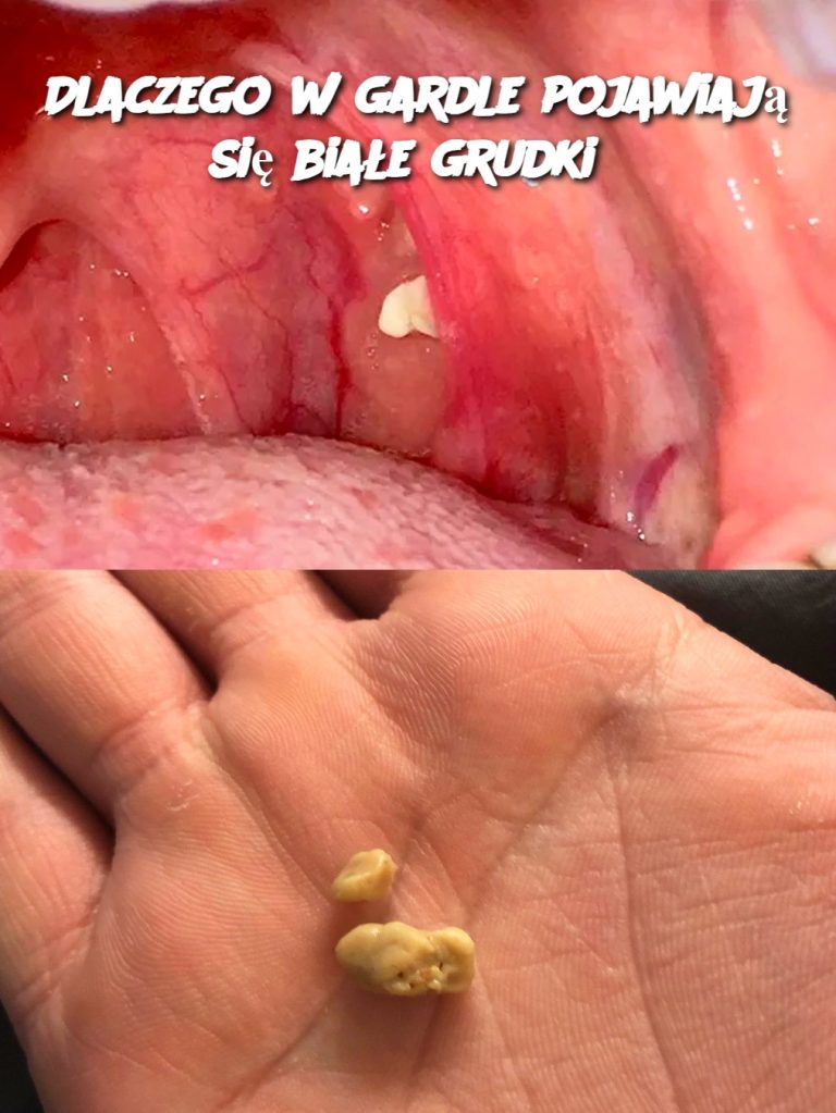 Dlaczego w gardle pojawiają się białe grudki?