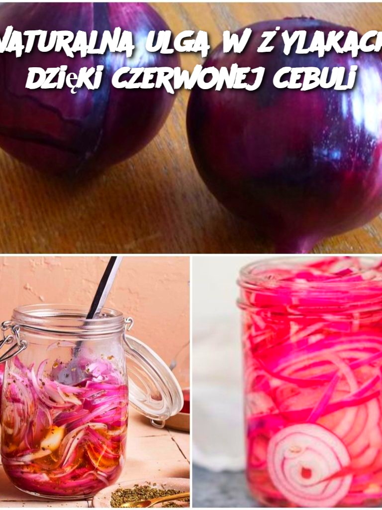 Naturalna ulga w żylakach dzięki czerwonej cebuli