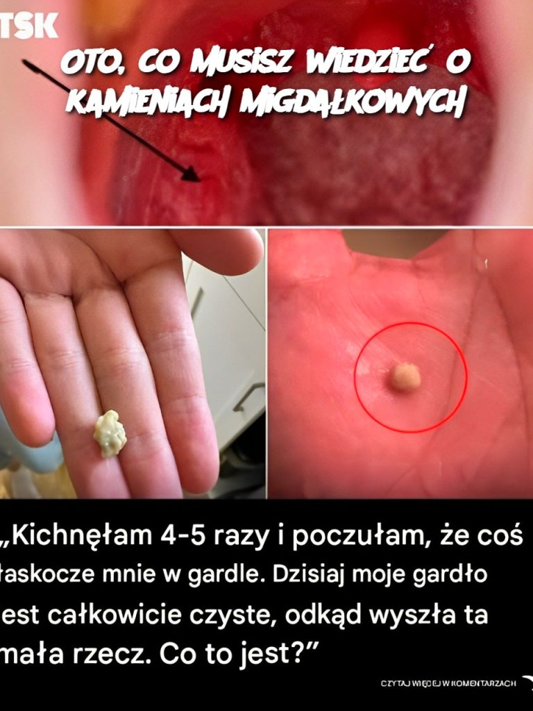 Oto, co musisz wiedzieć o kamieniach migdałkowych